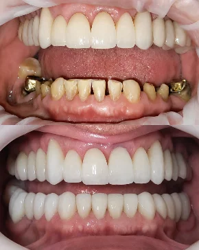 Facetas em porcelana — antes